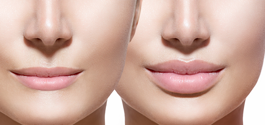 Lip Surgery Lip Lift In Bangalore Dr Pentyala s